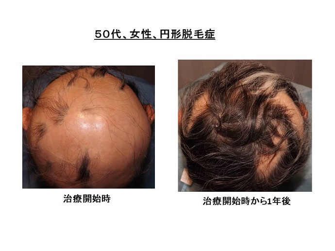 円形脱毛症　病院""